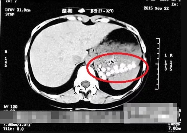 Biji Pearl Dalam Badan 1