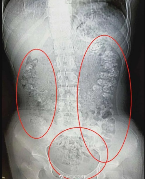 Biji Pearl Dalam Badan